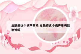 皮膚癬這個(gè)病嚴(yán)重嗎 皮膚癬這個(gè)病嚴(yán)重嗎能治好嗎