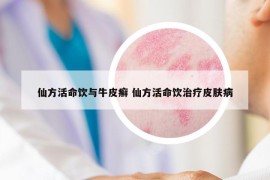 仙方活命飲與牛皮癬 仙方活命飲治療皮膚病