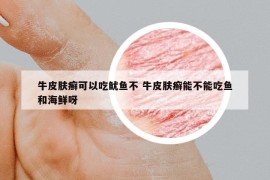 牛皮膚癬可以吃魷魚不 牛皮膚癬能不能吃魚和海鮮呀