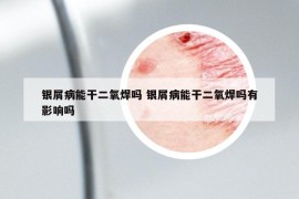 銀屑病能干二氧焊嗎 銀屑病能干二氧焊嗎有影響嗎