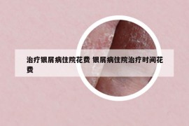 治療銀屑病住院花費(fèi) 銀屑病住院治療時(shí)間花費(fèi)