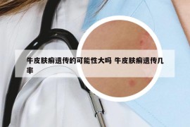 牛皮膚癬遺傳的可能性大嗎 牛皮膚癬遺傳幾率