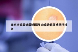 北京治銀屑病最好醫(yī)藥 北京治銀屑病醫(yī)院排名
