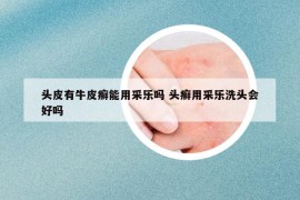 頭皮有牛皮癬能用采樂嗎 頭癬用采樂洗頭會(huì)好嗎