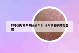 四平治療銀屑病應(yīng)當(dāng)華山 治療銀屑病好的醫(yī)院