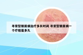尋常型銀屑病治療多長(zhǎng)時(shí)間 尋常型銀屑病一個(gè)療程是多久