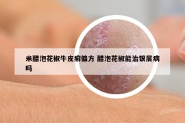 米醋泡花椒牛皮癬偏方 醋泡花椒能治銀屑病嗎