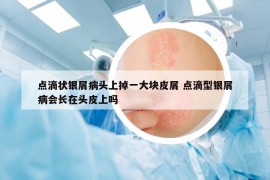點滴狀銀屑病頭上掉一大塊皮屑 點滴型銀屑病會長在頭皮上嗎