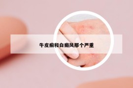 牛皮癬和白癜風那個嚴重