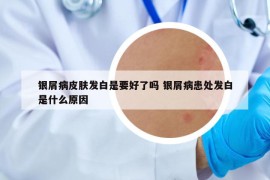 銀屑病皮膚發(fā)白是要好了嗎 銀屑病患處發(fā)白是什么原因