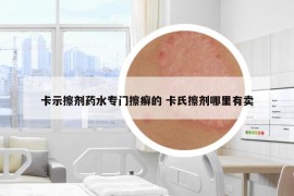 卡示擦劑藥水專門擦癬的 卡氏擦劑哪里有賣