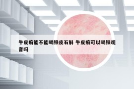 牛皮癬能不能喝鐵皮石斛 牛皮癬可以喝鐵觀音嗎