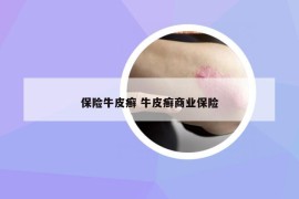 保險(xiǎn)牛皮癬 牛皮癬商業(yè)保險(xiǎn)