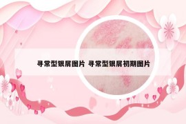 尋常型銀屑圖片 尋常型銀屑初期圖片