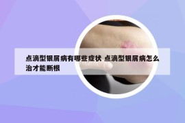 點滴型銀屑病有哪些癥狀 點滴型銀屑病怎么治才能斷根