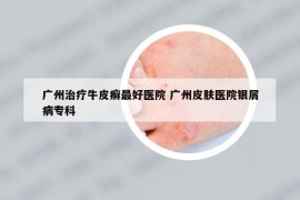 廣州治療牛皮癬最好醫(yī)院 廣州皮膚醫(yī)院銀屑病?？? /></a>		
		</figure>

		<header class=