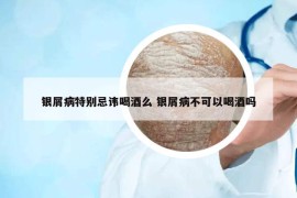 銀屑病特別忌諱喝酒么 銀屑病不可以喝酒嗎