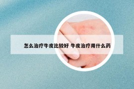 怎么治療牛皮比較好 牛皮治療用什么藥