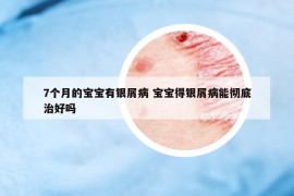 7個(gè)月的寶寶有銀屑病 寶寶得銀屑病能徹底治好嗎