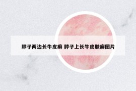 脖子兩邊長牛皮癬 脖子上長牛皮膚癬圖片