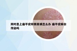 同時(shí)患上扁平疣和銀屑病怎么辦 扁平疣癬會(huì)傳染嗎
