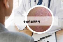 牛皮癬進展快嗎