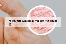 牛皮癬為什么聞起來(lái)臭 牛皮癬為什么奇癢難忍