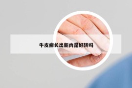 牛皮癬長(zhǎng)出新肉是好轉(zhuǎn)嗎