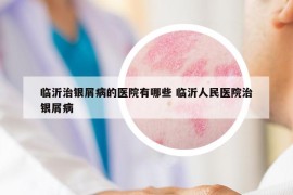 臨沂治銀屑病的醫(yī)院有哪些 臨沂人民醫(yī)院治銀屑病