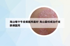 ?？谀膫€牛皮癬醫(yī)院最好 ?？谧顧?quán)威治療皮膚病醫(yī)院