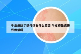 牛皮癬除了遺傳還有什么原因 牛皮癬是遺傳性疾病嗎