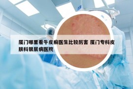 廈門哪里看牛皮癬醫(yī)生比較厲害 廈門專科皮膚科銀屑病醫(yī)院