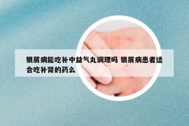 銀屑病能吃補(bǔ)中益氣丸調(diào)理嗎 銀屑病患者適合吃補(bǔ)腎的藥么