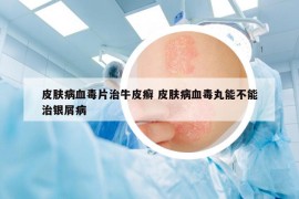 皮膚病血毒片治牛皮癬 皮膚病血毒丸能不能治銀屑病