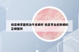 南昌哪家醫(yī)院治牛皮癬好 南昌專治皮膚病的正規(guī)醫(yī)院