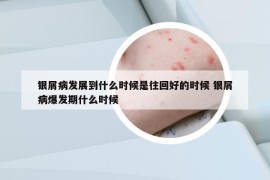 銀屑病發(fā)展到什么時候是往回好的時候 銀屑病爆發(fā)期什么時候