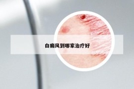 白癜風(fēng)到哪家治療好