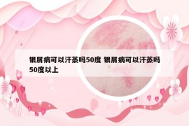 銀屑病可以汗蒸嗎50度 銀屑病可以汗蒸嗎50度以上