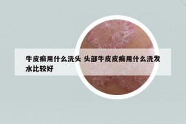 牛皮癬用什么洗頭 頭部牛皮皮癬用什么洗發(fā)水比較好