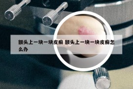 額頭上一塊一塊皮癬 額頭上一塊一塊皮癬怎么辦