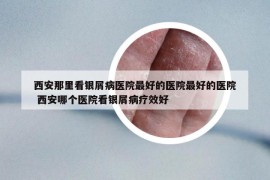 西安那里看銀屑病醫(yī)院最好的醫(yī)院最好的醫(yī)院 西安哪個醫(yī)院看銀屑病療效好