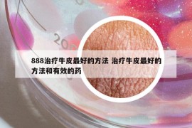 888治療牛皮最好的方法 治療牛皮最好的方法和有效的藥