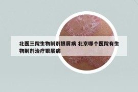 北醫(yī)三院生物制劑銀屑病 北京哪個(gè)醫(yī)院有生物制劑治療銀屑病
