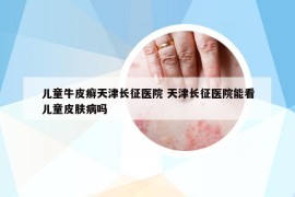 兒童牛皮癬天津長征醫(yī)院 天津長征醫(yī)院能看兒童皮膚病嗎
