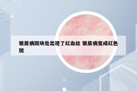 銀屑病斑塊處出現(xiàn)了紅血絲 銀屑病變成紅色斑