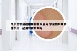 血瘀型銀屑病服用郁金銀屑片 郁金銀屑片和什么藥一起用對銀屑病好