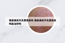 銀屑病關(guān)節(jié)炎費(fèi)用高嗎 銀屑病關(guān)節(jié)炎費(fèi)用高嗎能治好嗎