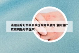 洛陽(yáng)治療好的銀屑病醫(yī)院哪家最好 洛陽(yáng)治療皮膚病最好的醫(yī)院