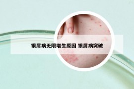 銀屑病無限增生原因 銀屑病突破
