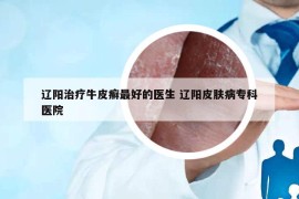 遼陽治療牛皮癬最好的醫(yī)生 遼陽皮膚病?？漆t(yī)院